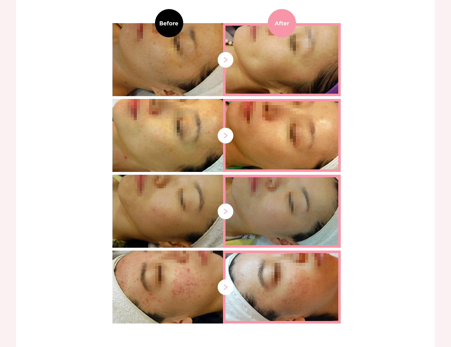 여드름 치료 안내 이미지