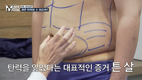 부위별 지방흡입 안내 이미지