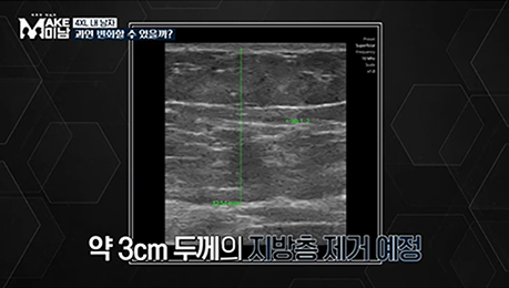 부위별 지방흡입 안내 이미지